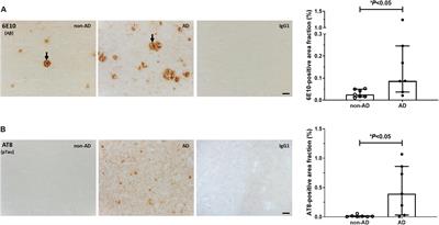 Increased Inflammation and Unchanged Density of Synaptic Vesicle Glycoprotein 2A (SV2A) in the Postmortem Frontal Cortex of Alzheimer’s Disease Patients
